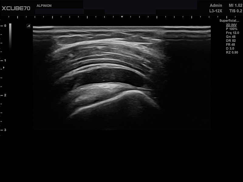 Liver in CF mode