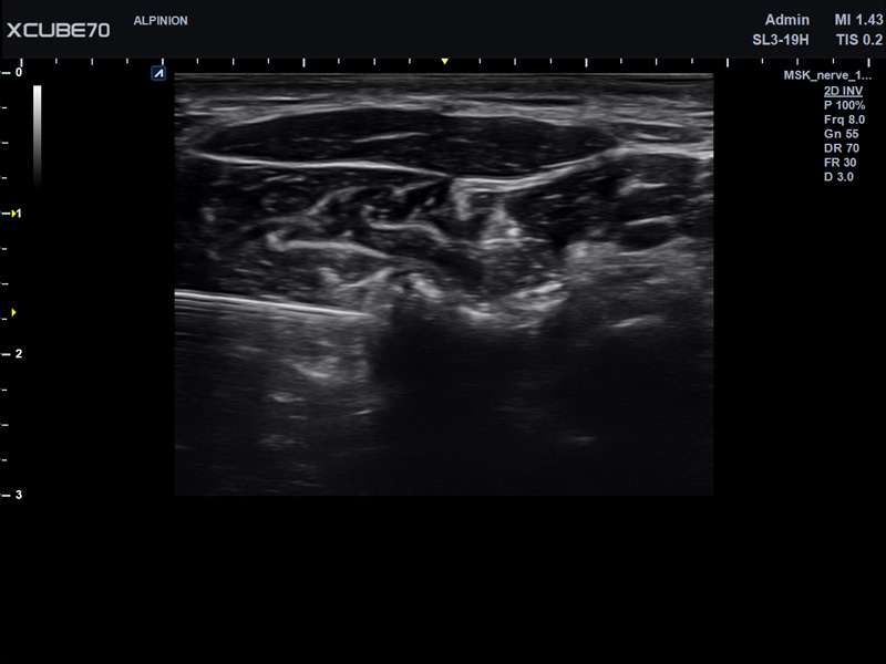 Liver in CF mode