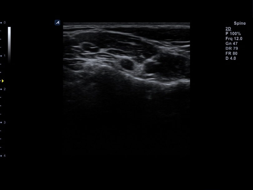 Liver in CF mode