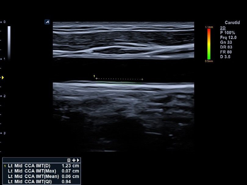 Liver in CF mode