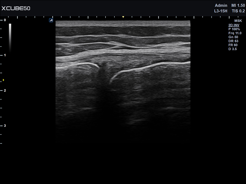 Liver in CF mode