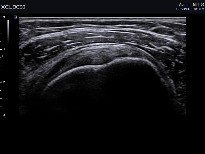 Shoulder in 2D mode